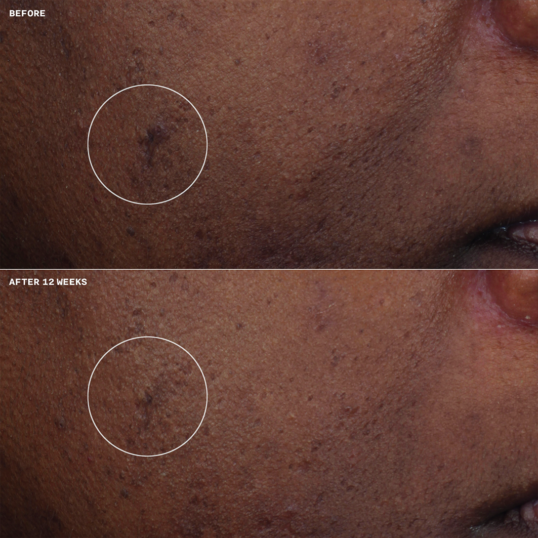 Even Better Clinical Brightening Moisturizer